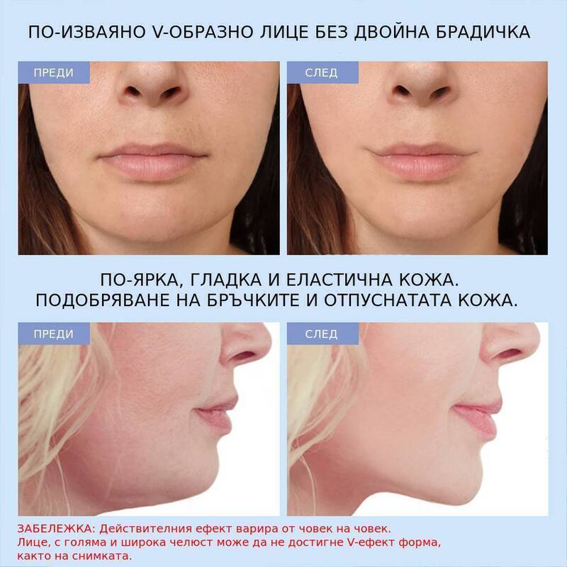Премахване на двойната брадичка с V-образен лифтинг уред.