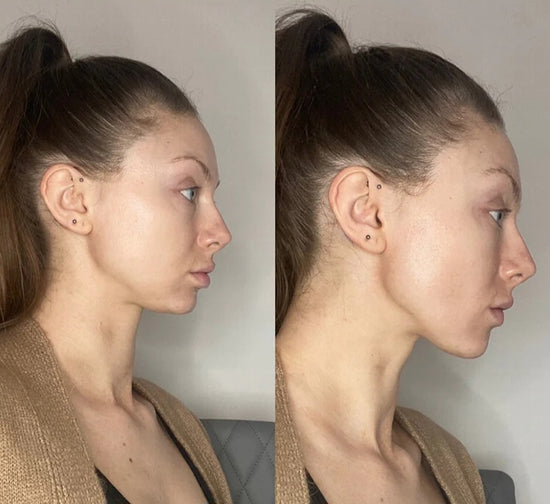 Преди и след използване на 3D ролера за лице.